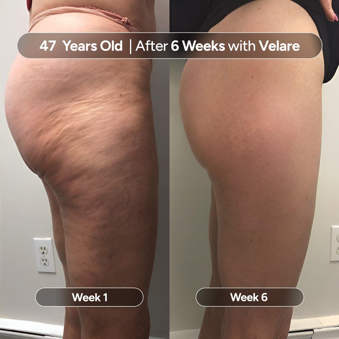 VELIORA™ Anti-Cellulite Massage Oil